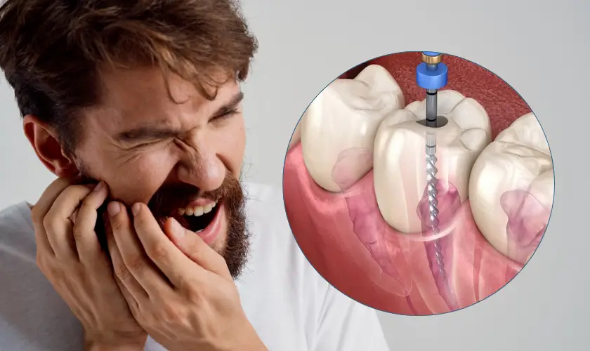 Root canal Treatment